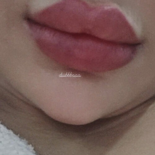 تزریق ژل لب و صورت بابرند کره ای